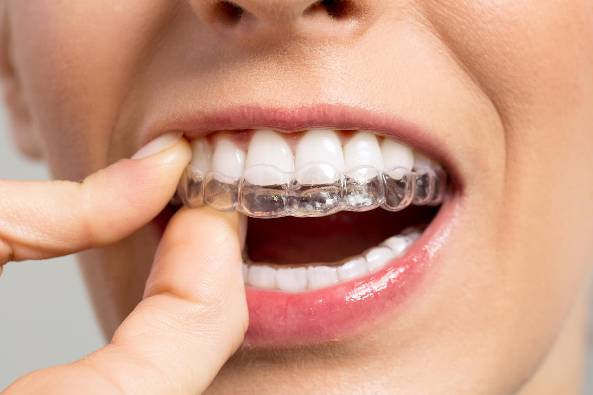Fitting Invisalign® in Pompano Beach