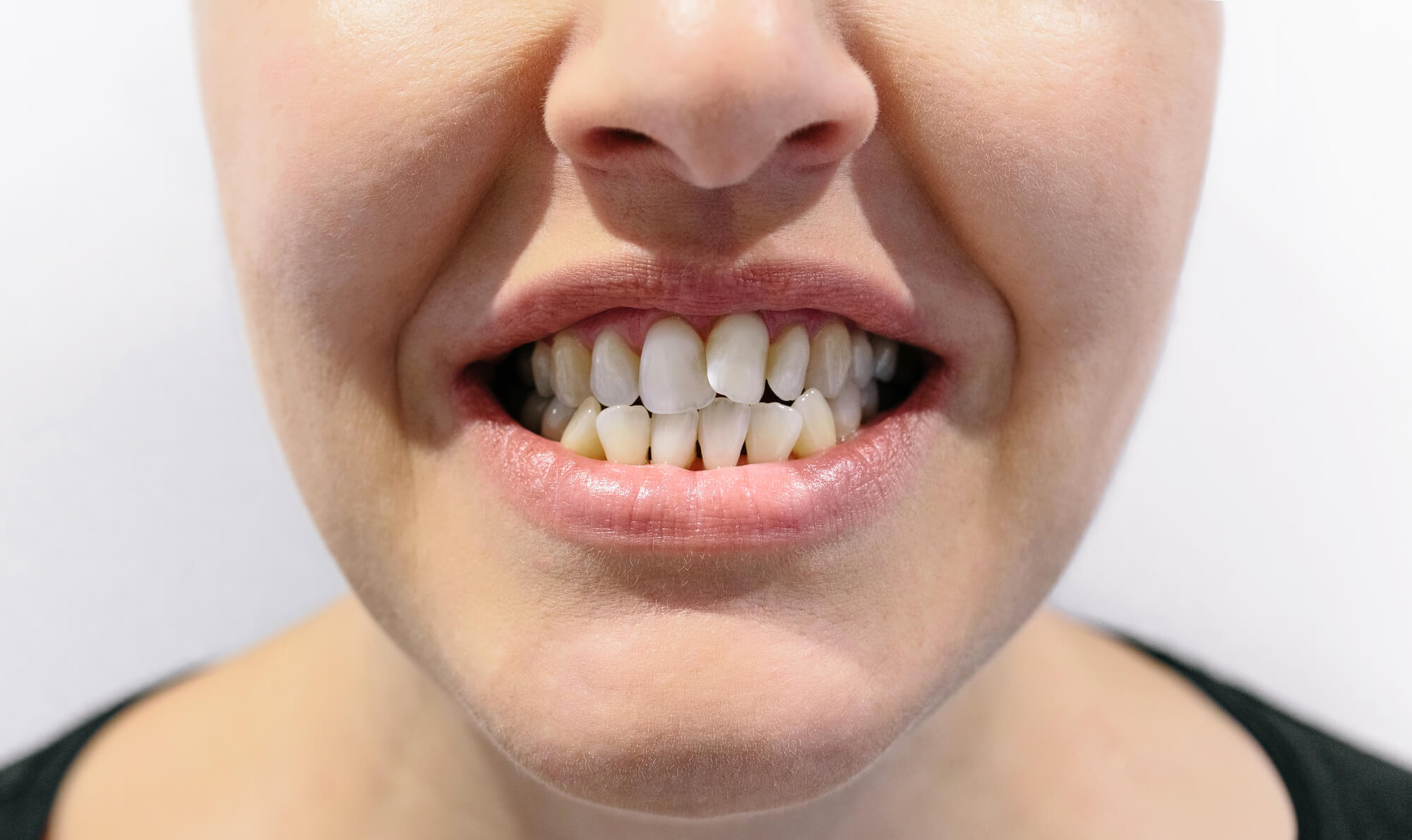 patient showing her teeth to an Orthodontist in 33062
