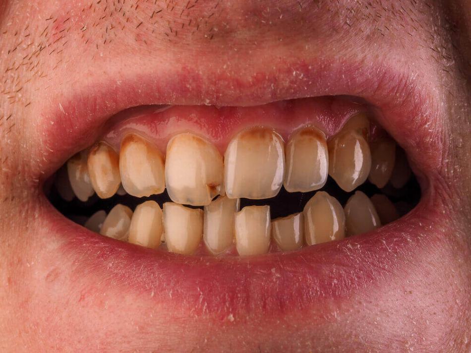 An-unhealthy-mouth-with-a-periodontist-in-Pompano-Beach.