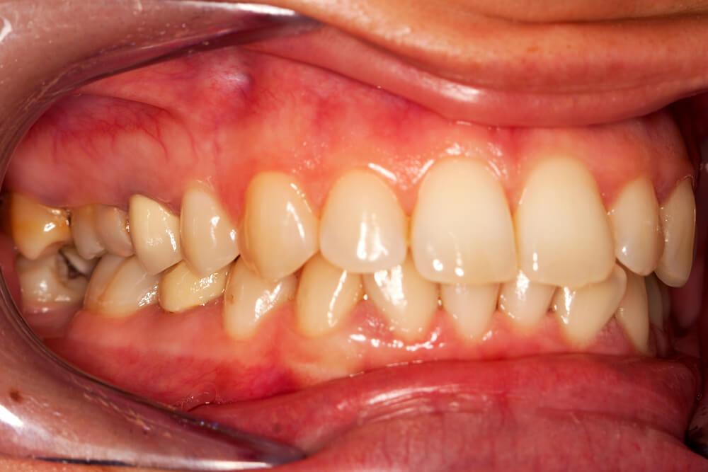 unhealthy gums with a dentist in 33062.
