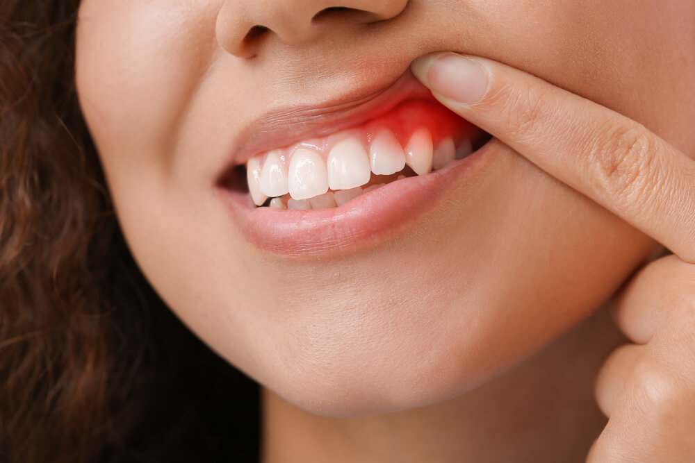 Swollen gums with a dentist in 33062.