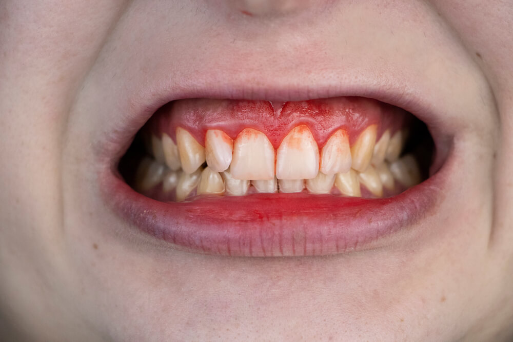 dentist in 33062 will treat bleeding gums.