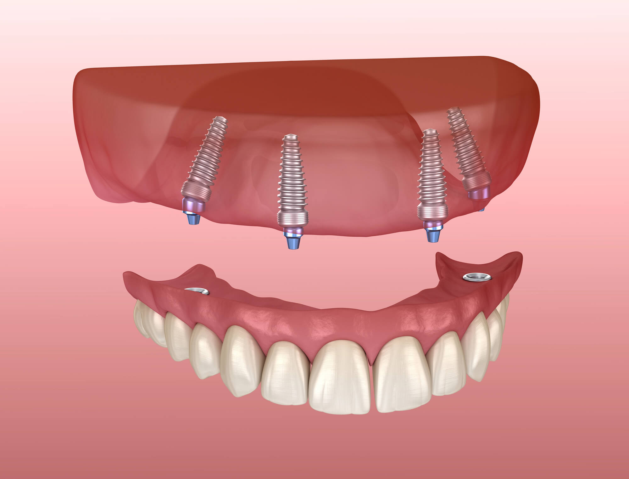 All-on-4 Dental Implants in 33062