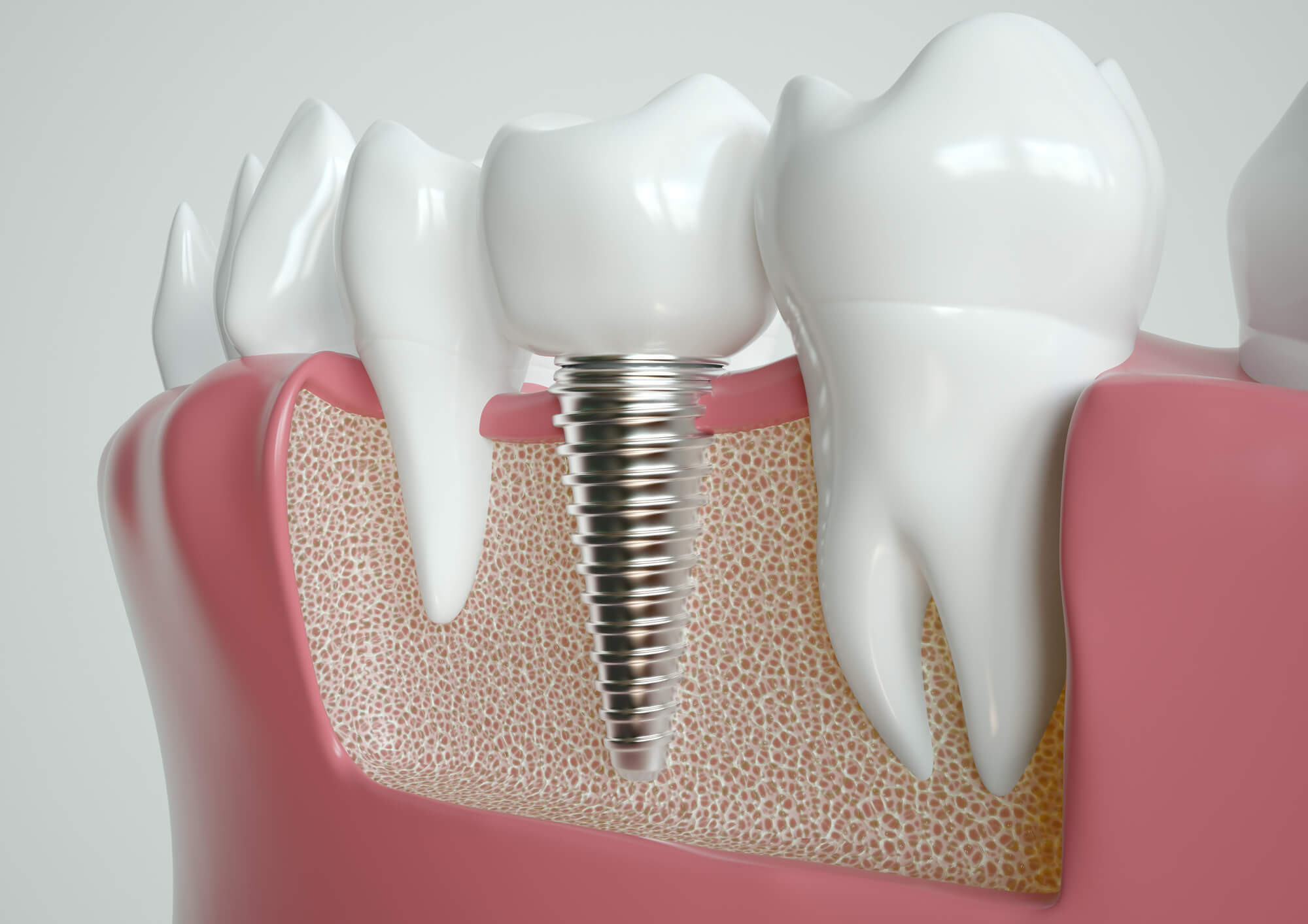 Risks of Dental Implants in Pompano Beach