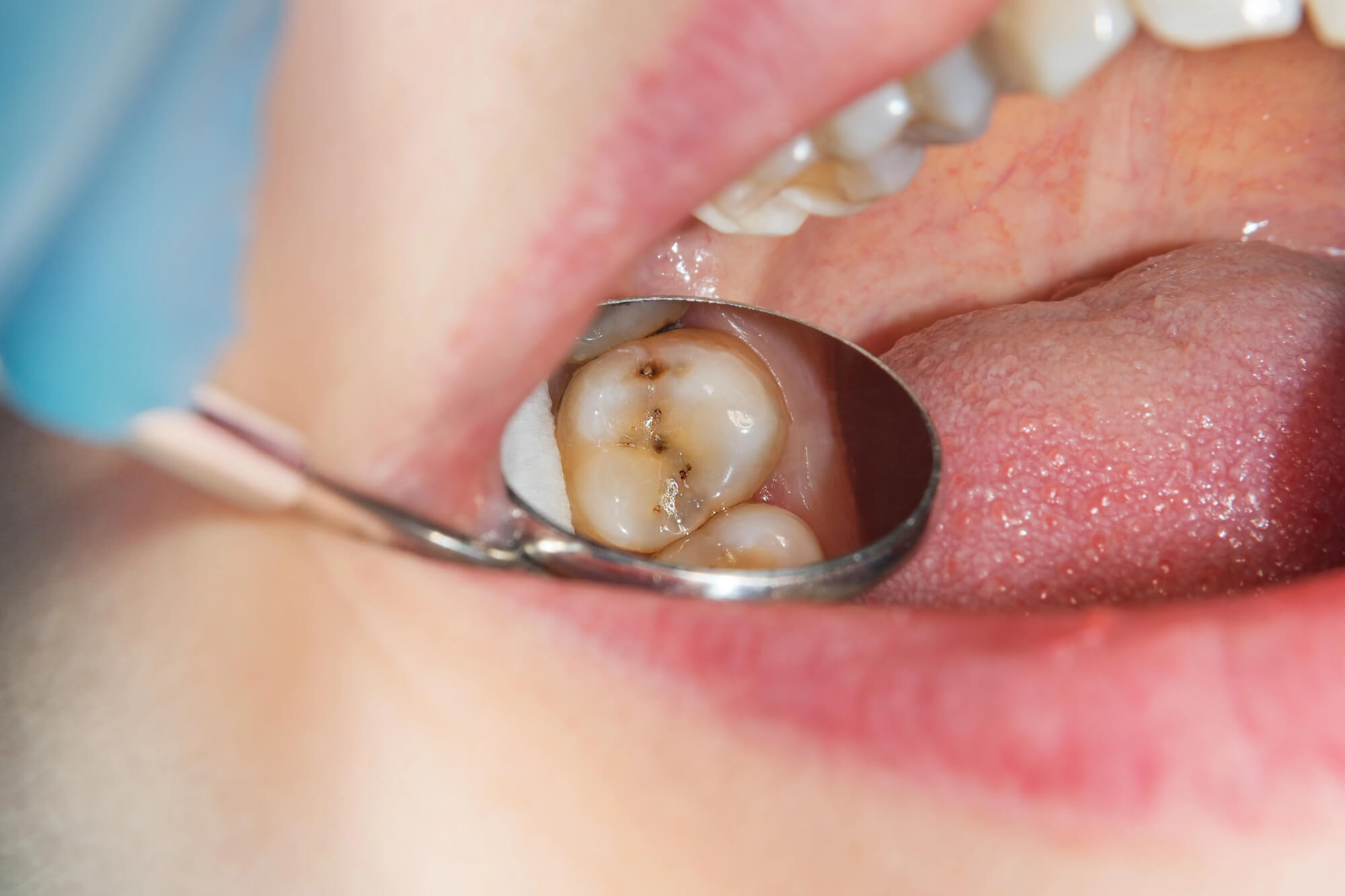 Can a Dentist in 33062 Reverse a Cavity