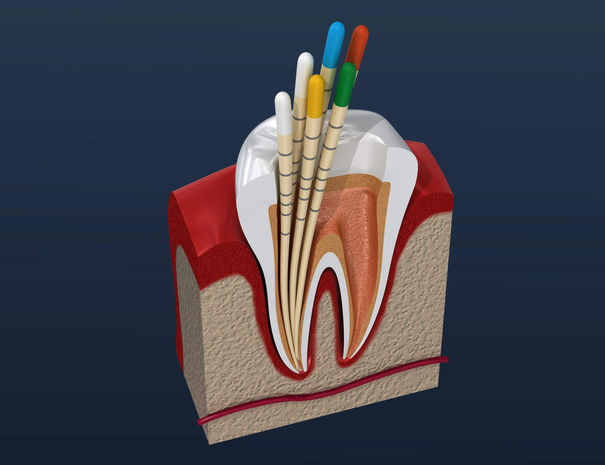 Illustration of Root Canal with a Dentist Near Pompano Beach Airpark