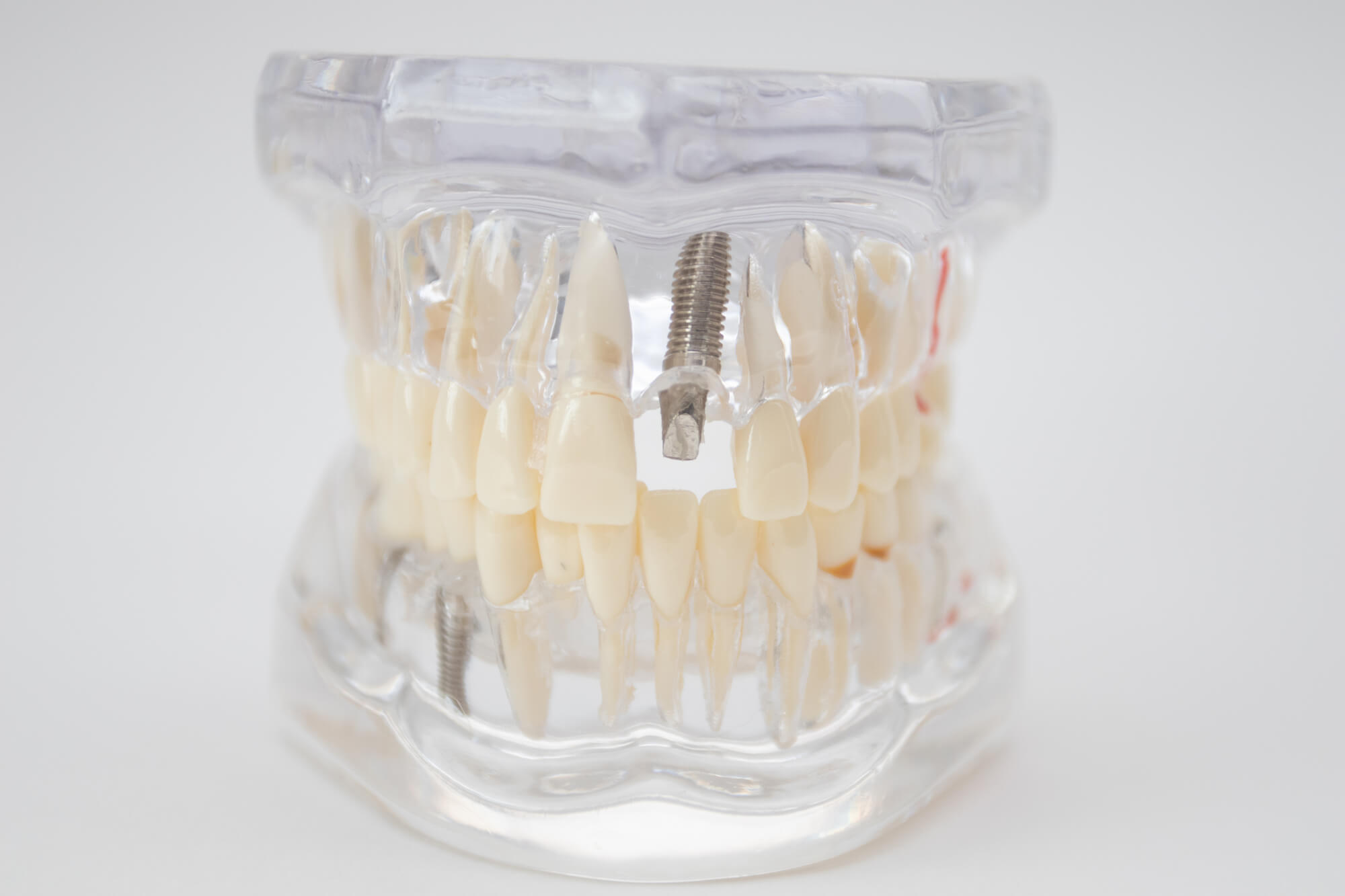 Illustration of an Implant from an Oral Surgeon in Pompano Beach