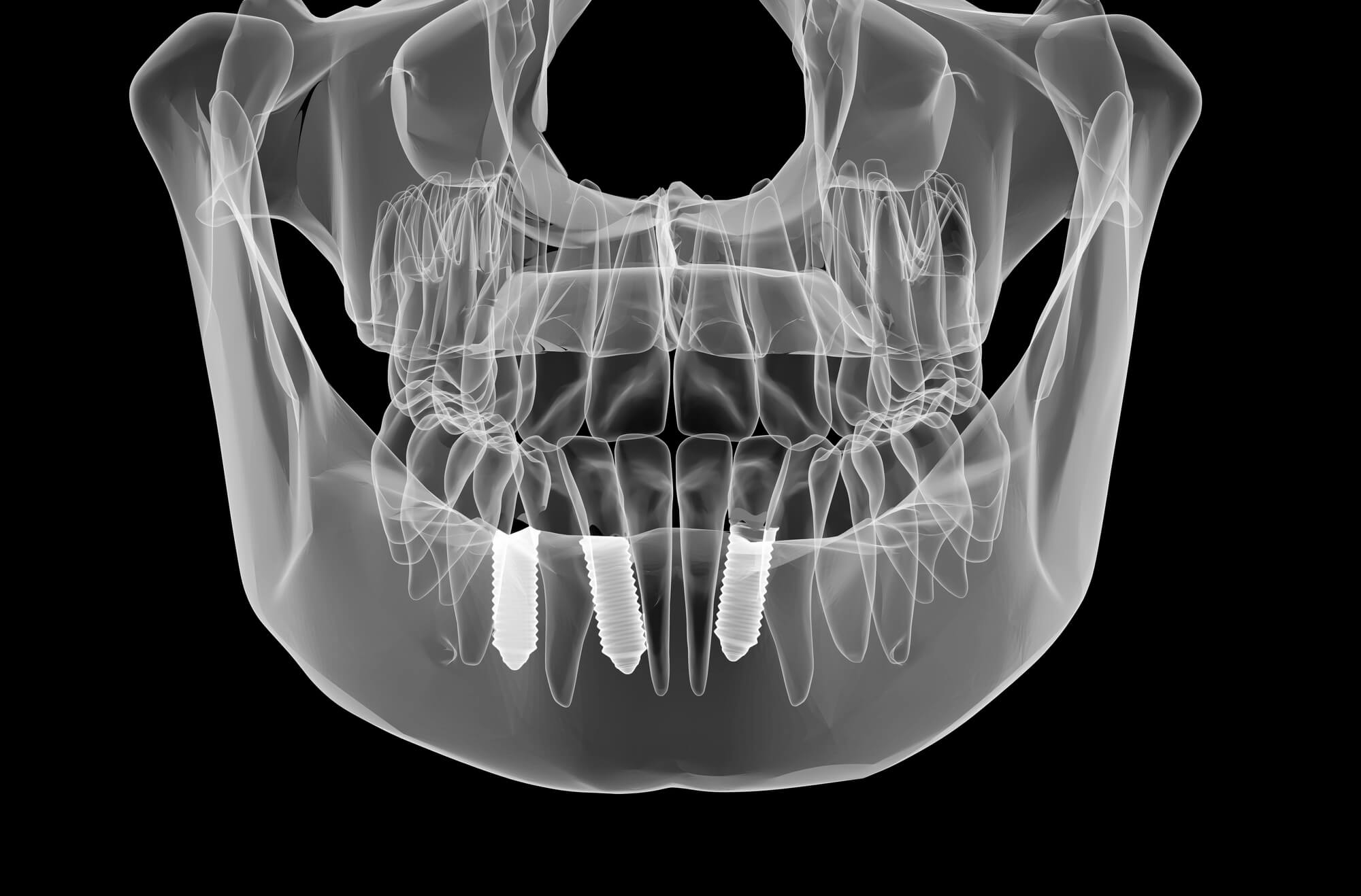 How Dental Implants in Pompano Beach Prevent Bone Resorption