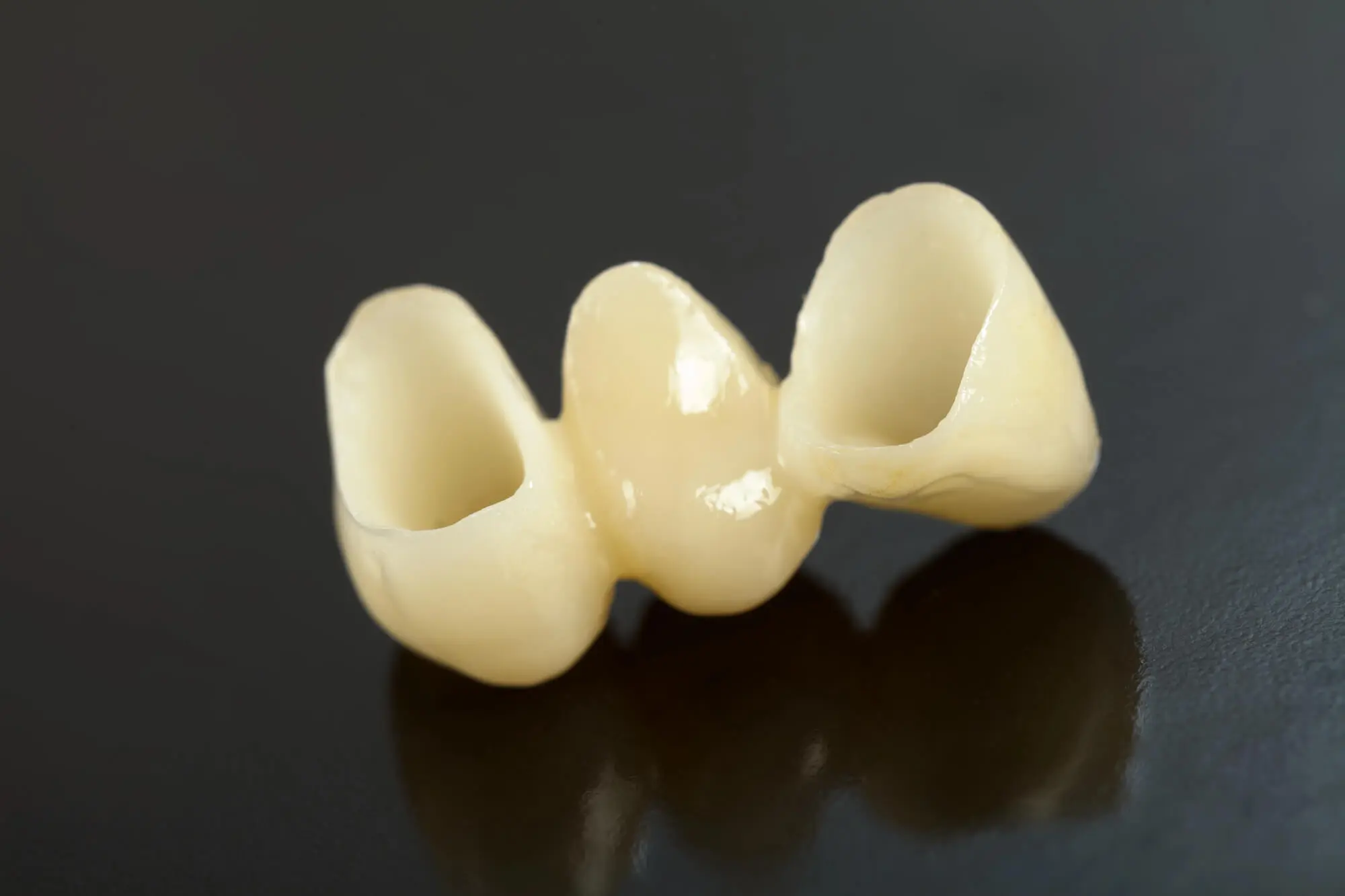 Dislodged Dental Bridges in Pompano Beach