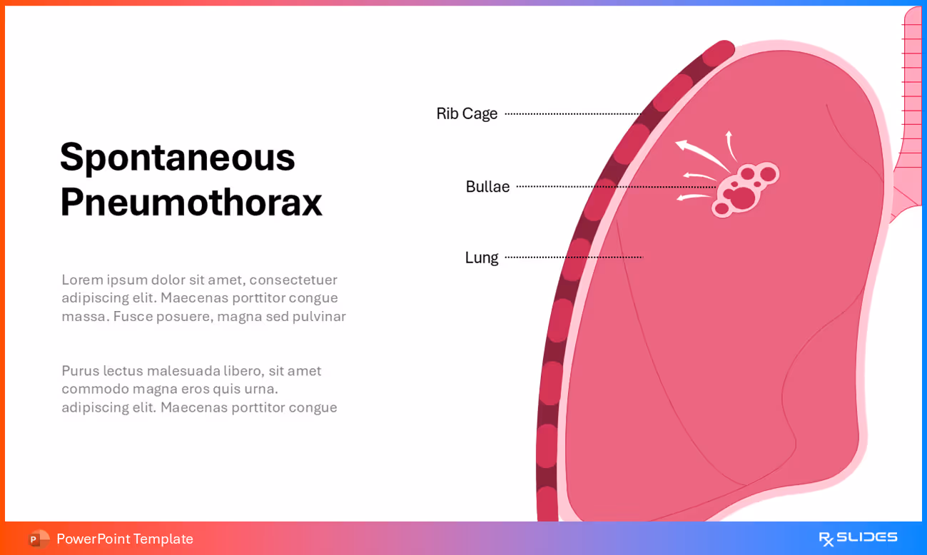 Pathogenesis of Spontaneous Pneumothorax