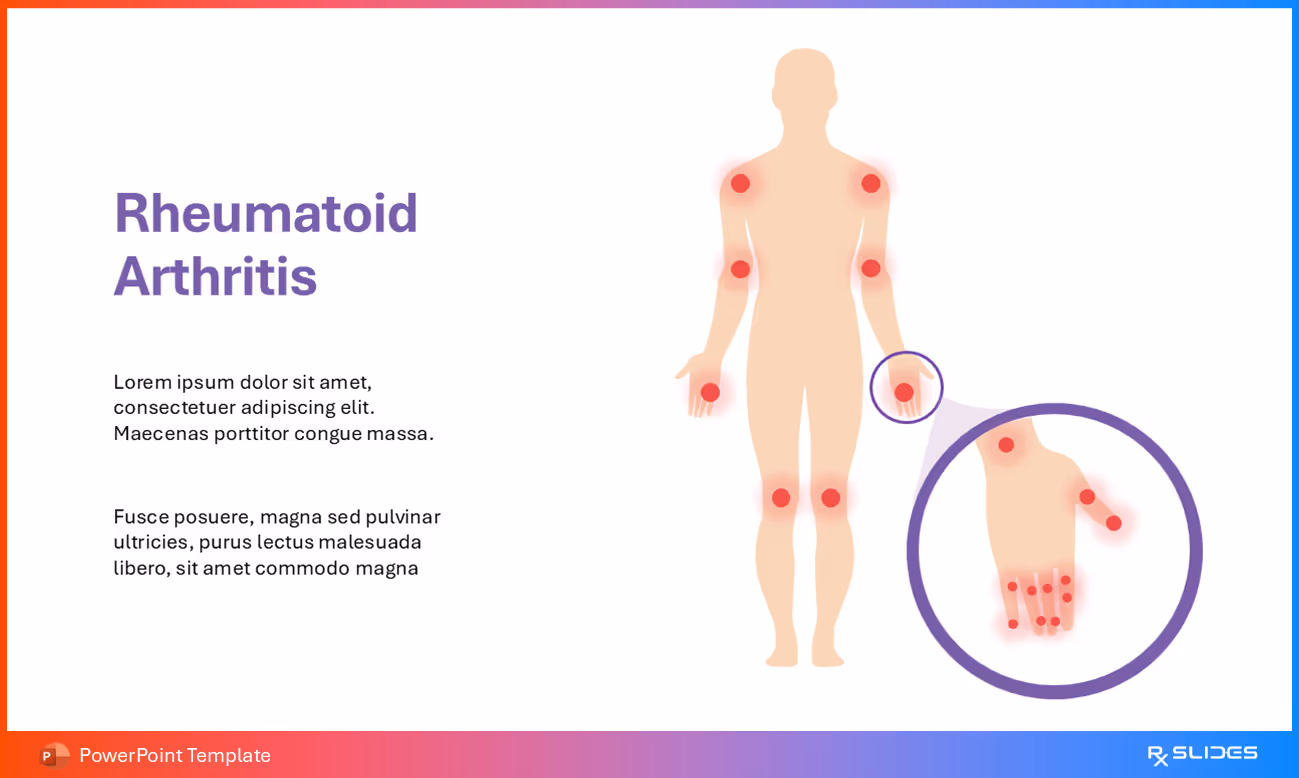 Rheumatoid Arthritis Definition Slide