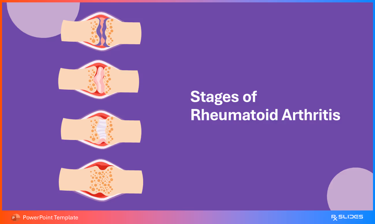 Stages of Rheumatoid Arthritis – Section Slide