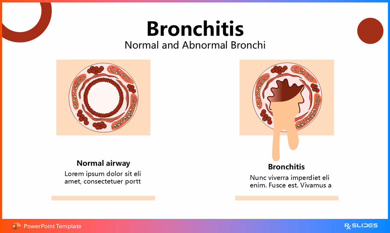 Normal Alveoli and Affected Bronchi