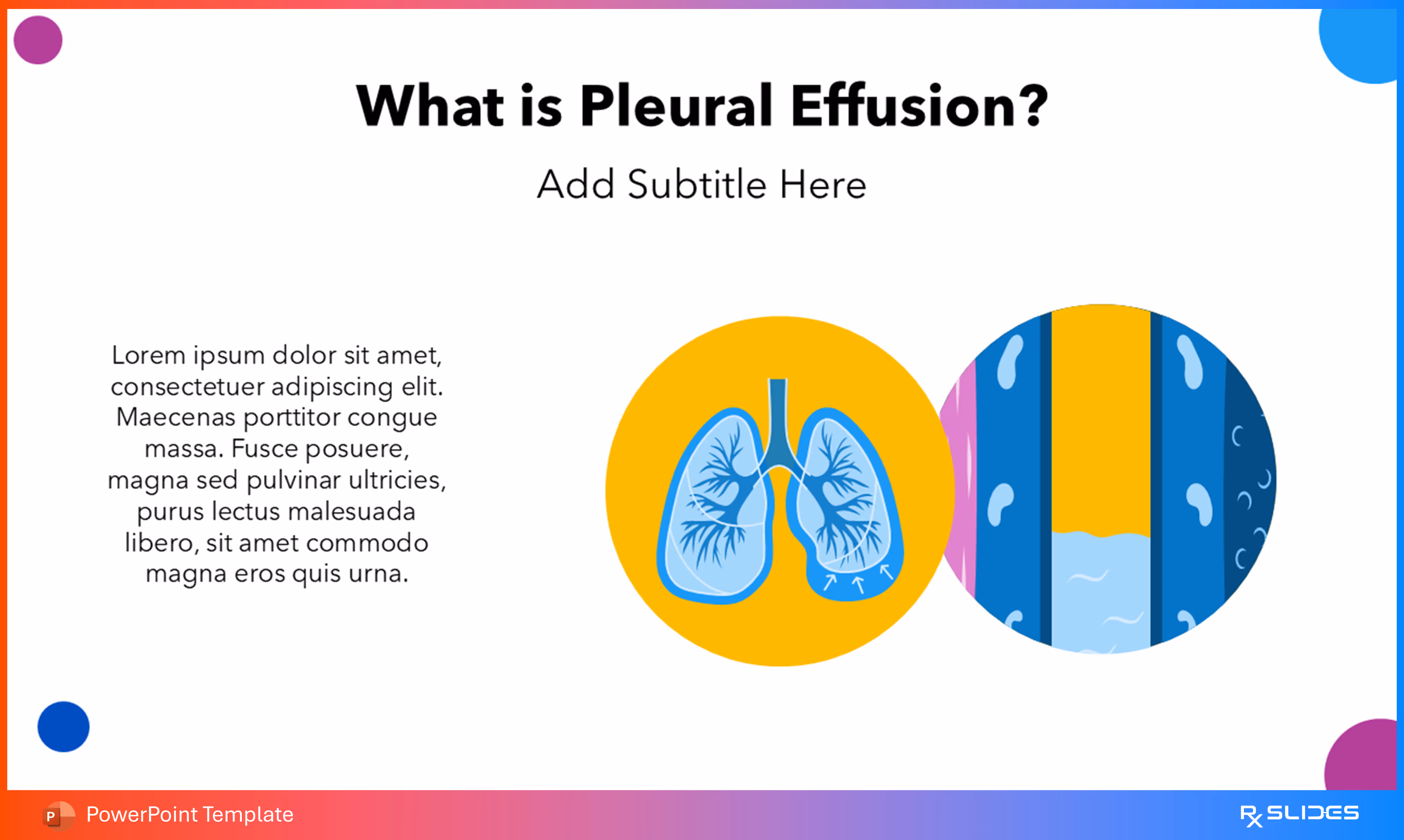 What is Pleural Effusion?