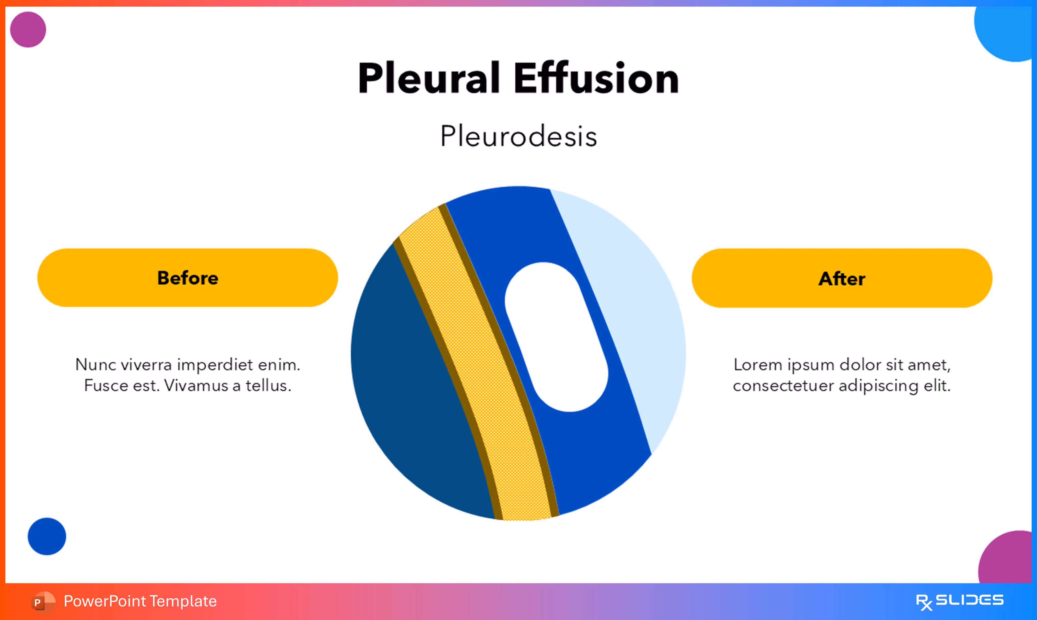 Pleurodesis PowerPoint 