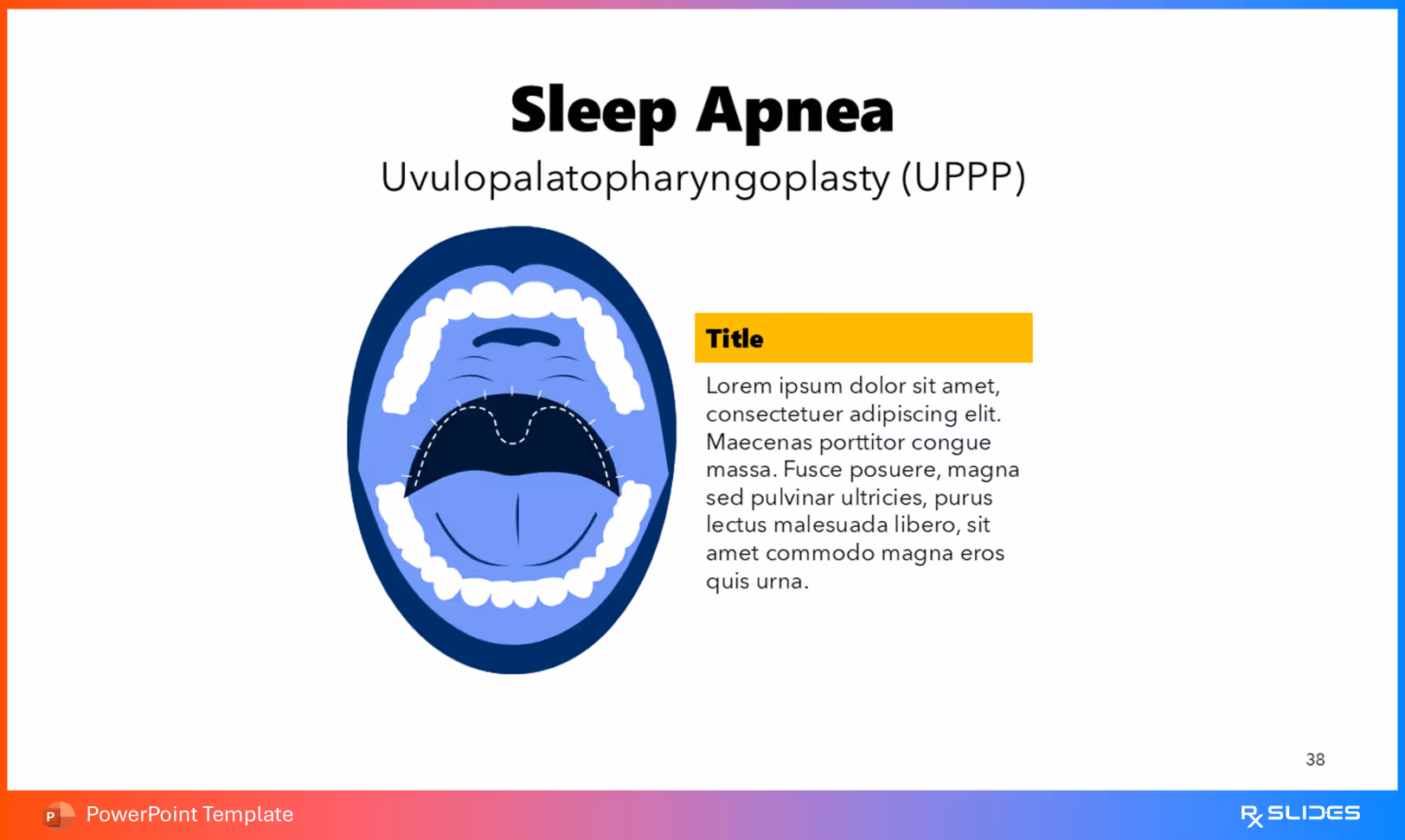 Uvulopalatopharyngoplasty (UPPP) Surgery—Animated Design