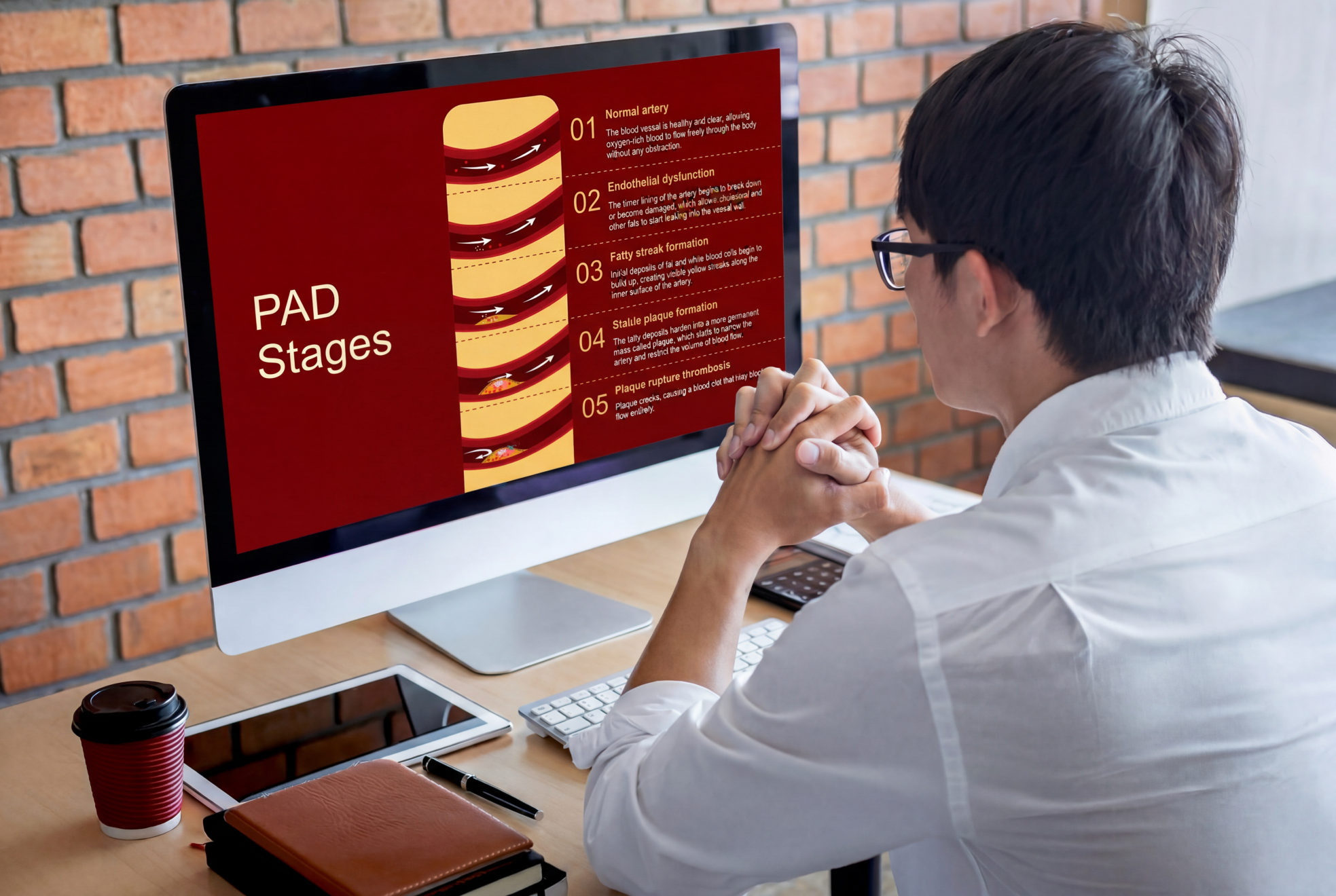 Healthcare learner reviewing peripheral arterial disease stages using an editable Peripheral Arterial Disease Overview Presentation Template on a desktop computer.