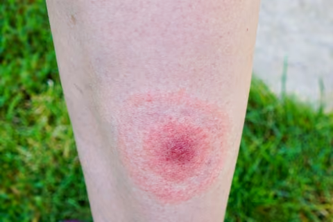 Lyme Disease is one of the common causes of muscle pain.
