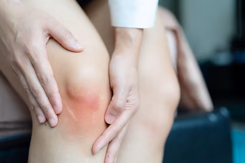 Discolouration is a common sign and symptom of broken bones.
