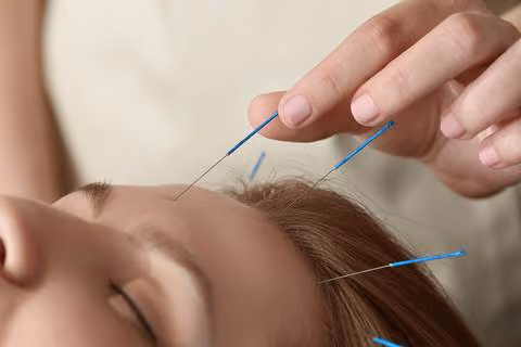Type #5: Scalp Acupuncture