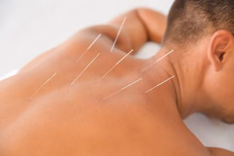 Type #2: Japanese Acupuncture