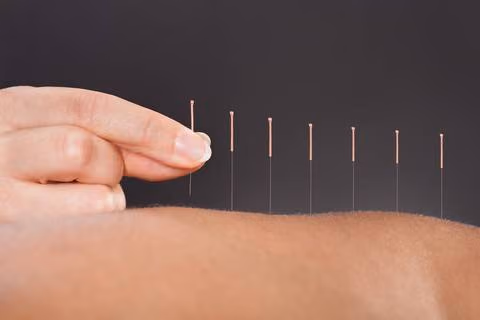 Type #1 - Traditional Chinese Acupuncture
