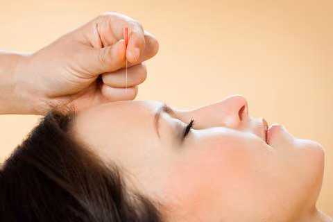 Acupuncture is one of the best concussion remedies.