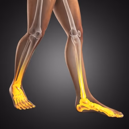 Improving Bone Health to Reduce the Risk of Fracture