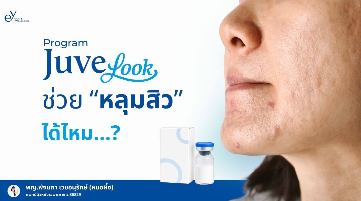 Juvelook ช่วยแก้หลุมสิวได้มั้ย? มีการทำงานอย่างไร?