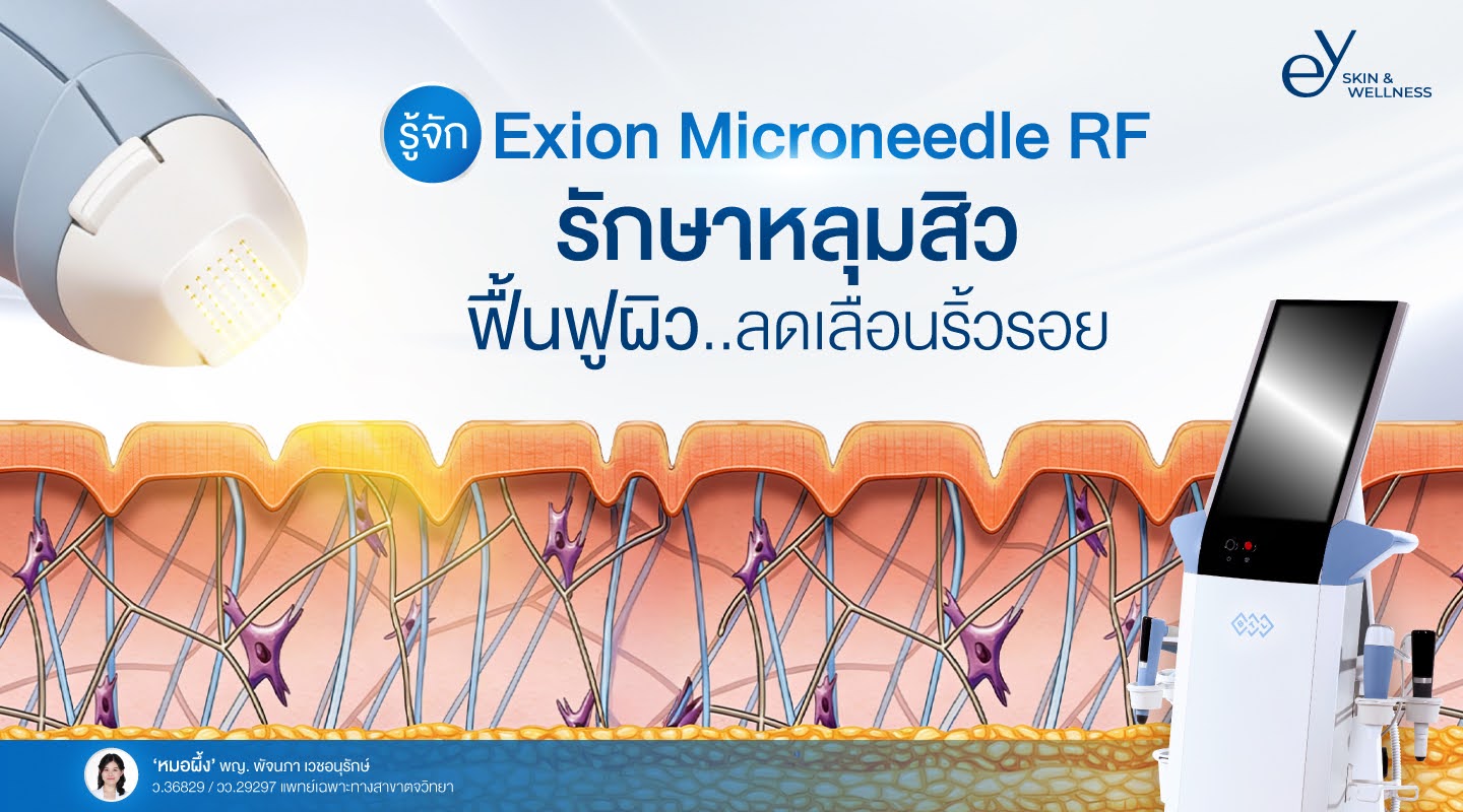 รู้จัก Exion Microneedle RF: รักษาหลุมสิว ฟื้นฟูผิว ลดเลือนริ้วรอย