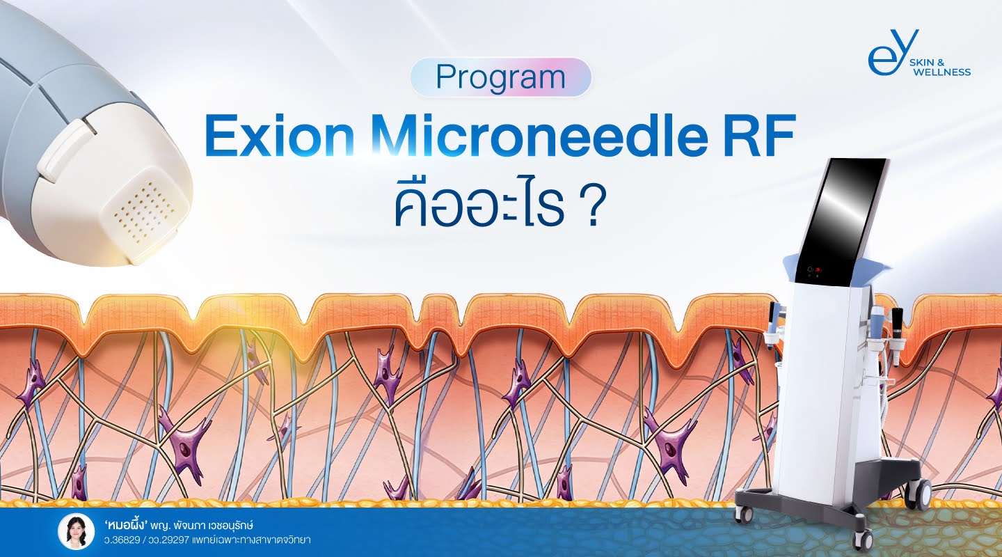 Exion Microneedle RF รักษาหลุมสิวตรงจุด ปลอดภัย ไม่ต้องพักหน้า