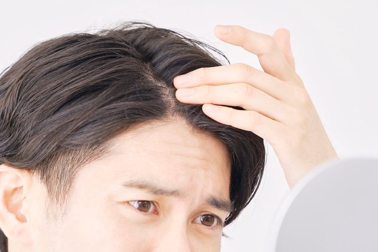 男性型脱毛症の治療 ー はげ・薄毛の兆候と見分け方