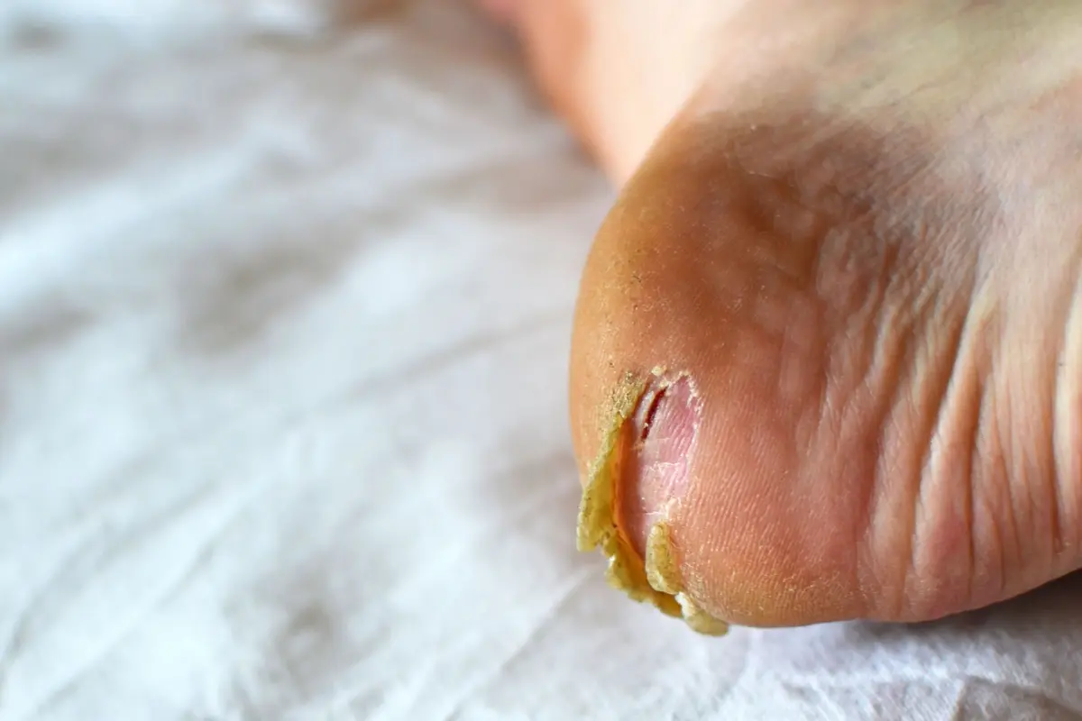 How to Manage Early Stage Dry Feet Diabetes Tips for Healthy Skin and Blood Sugar Control