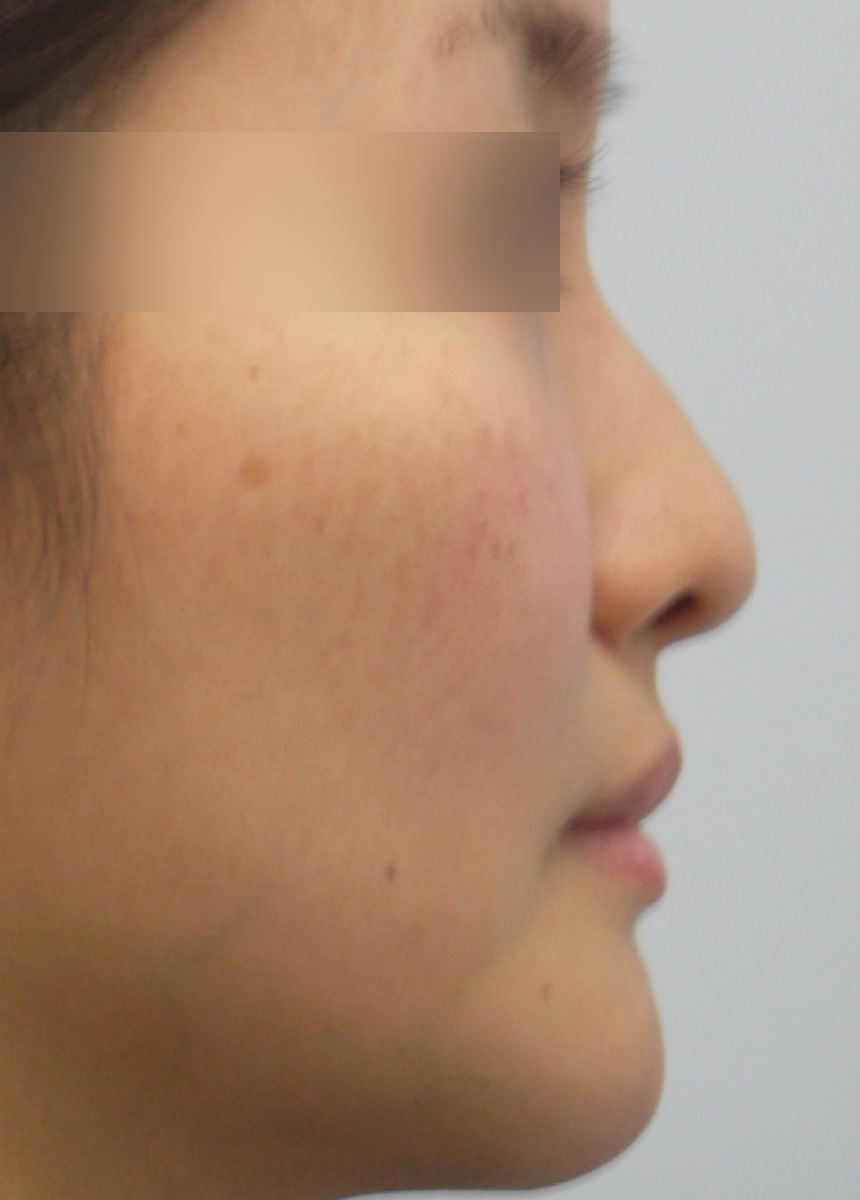 Asian Rhinoplasty in NYC | Tribeca Aesthetics®