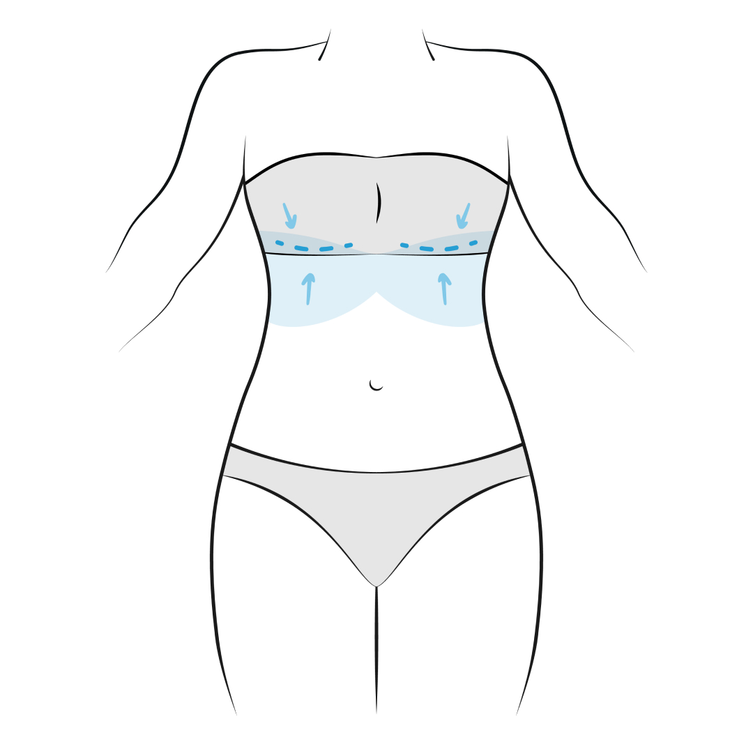 upper body lift surgery scars - skin removal surgery after weight loss - upper body lift near me