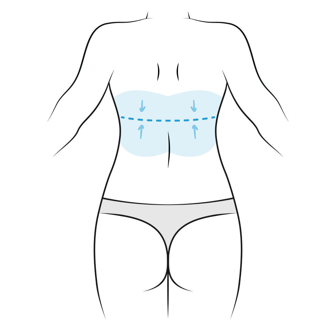 upper body lift surgery scars - skin removal surgery after weight loss - upper body lift near me