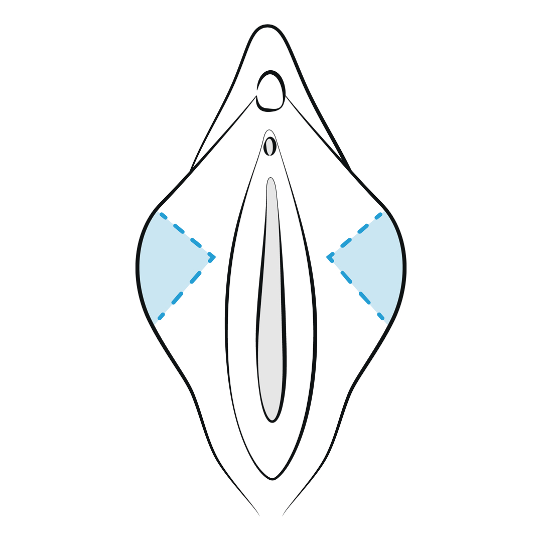 wedge labiaplasty scars - labiaplasty near me