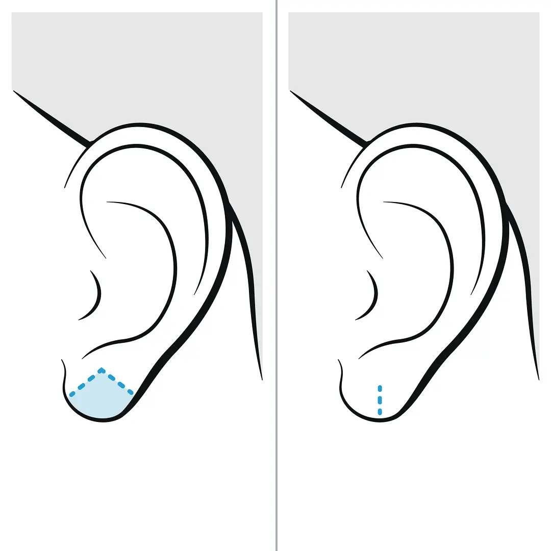 earlobe repair surgery scars