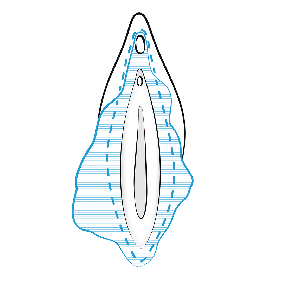 trim labiaplasty scar - labiaplasty near me