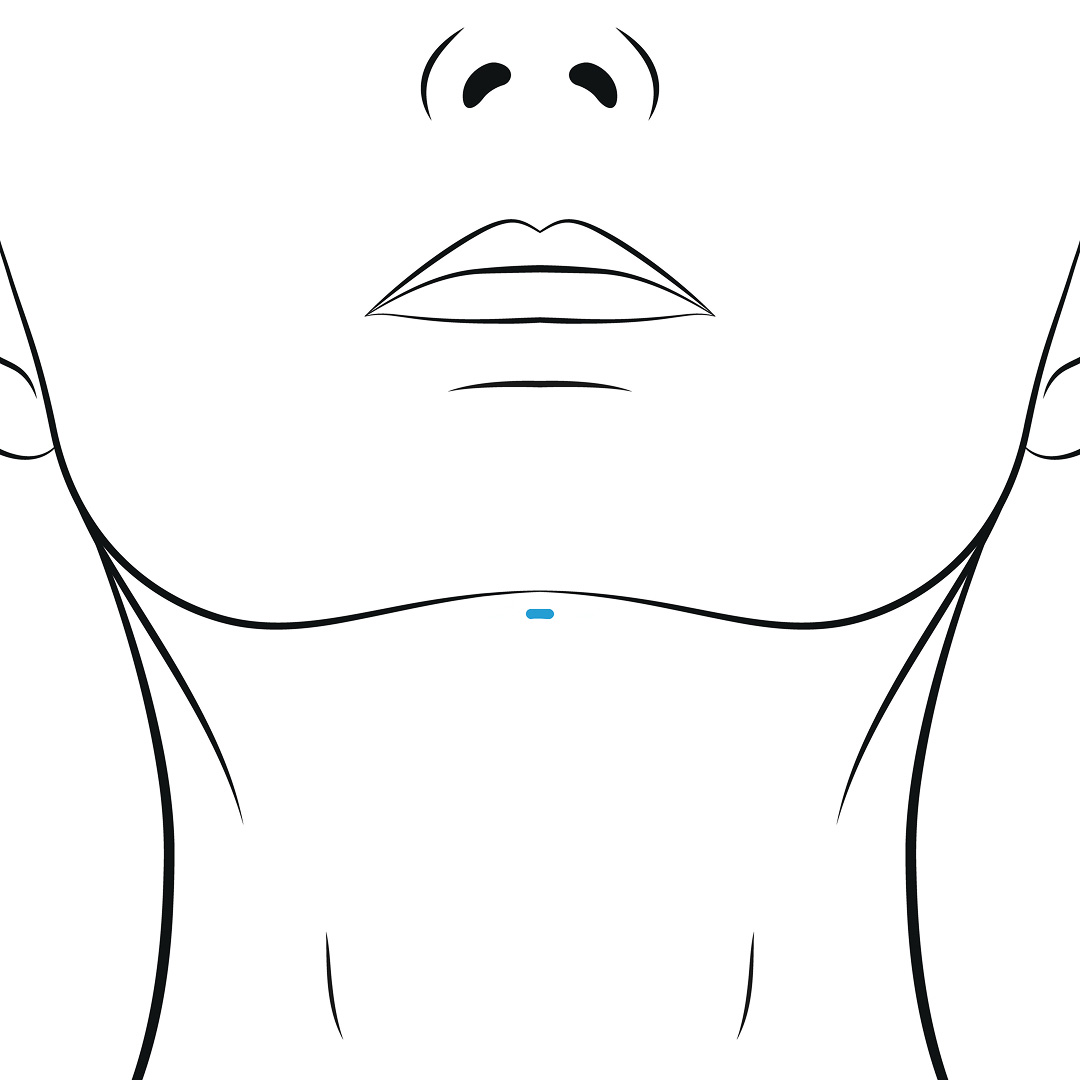 double chin liposuction - submental lipo - lipo scars - double chin lipo near me