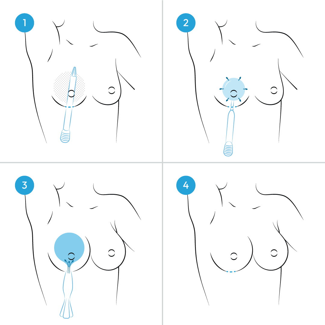 how is Preservé breast augmentation performed? How does Preservé breast augmentation work?