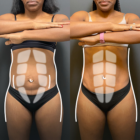 Diastasis recti is the separation and stretching of the abdominal muscles that result in a loss of core strength and control. Pregnancy, weight loss, weight gain, and even aging cause the muscles to separate and stretch. Muscle repair is often included with a tummy tuck and acts as an internal corset to strengthen the core, relieve lower back pain, and provide additional shape to the torso.