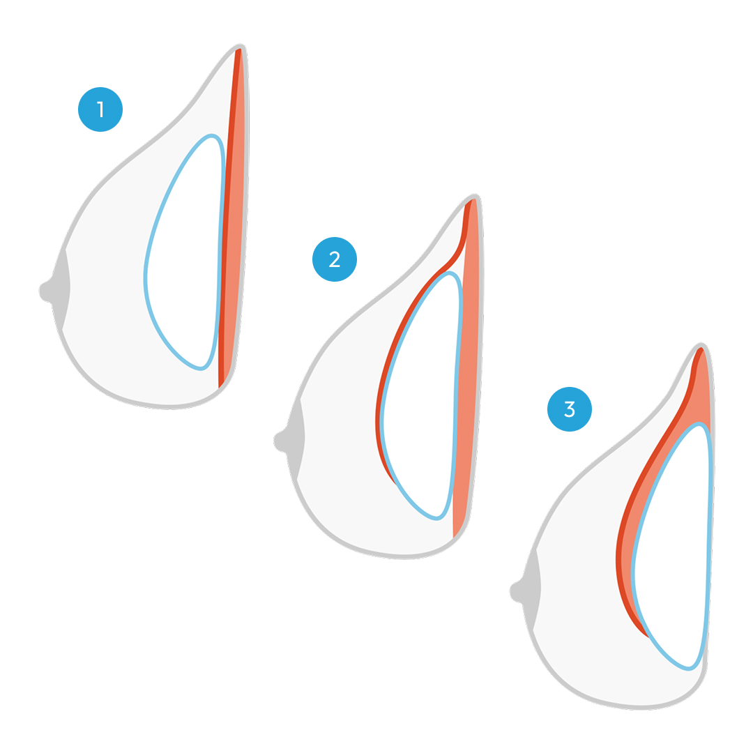 Breast implant placement - Board-Certified Plastic Surgeon in San Antonio Texas - Dr. Marcos Lopez