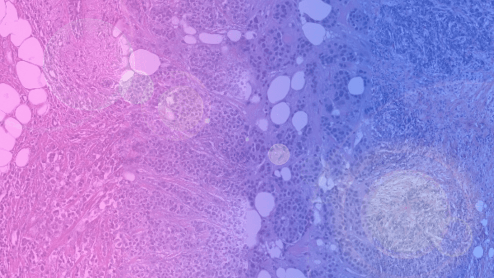 A combined image of four histology images of breast cancer tissue ranging from low-risk to high-risk of relapse