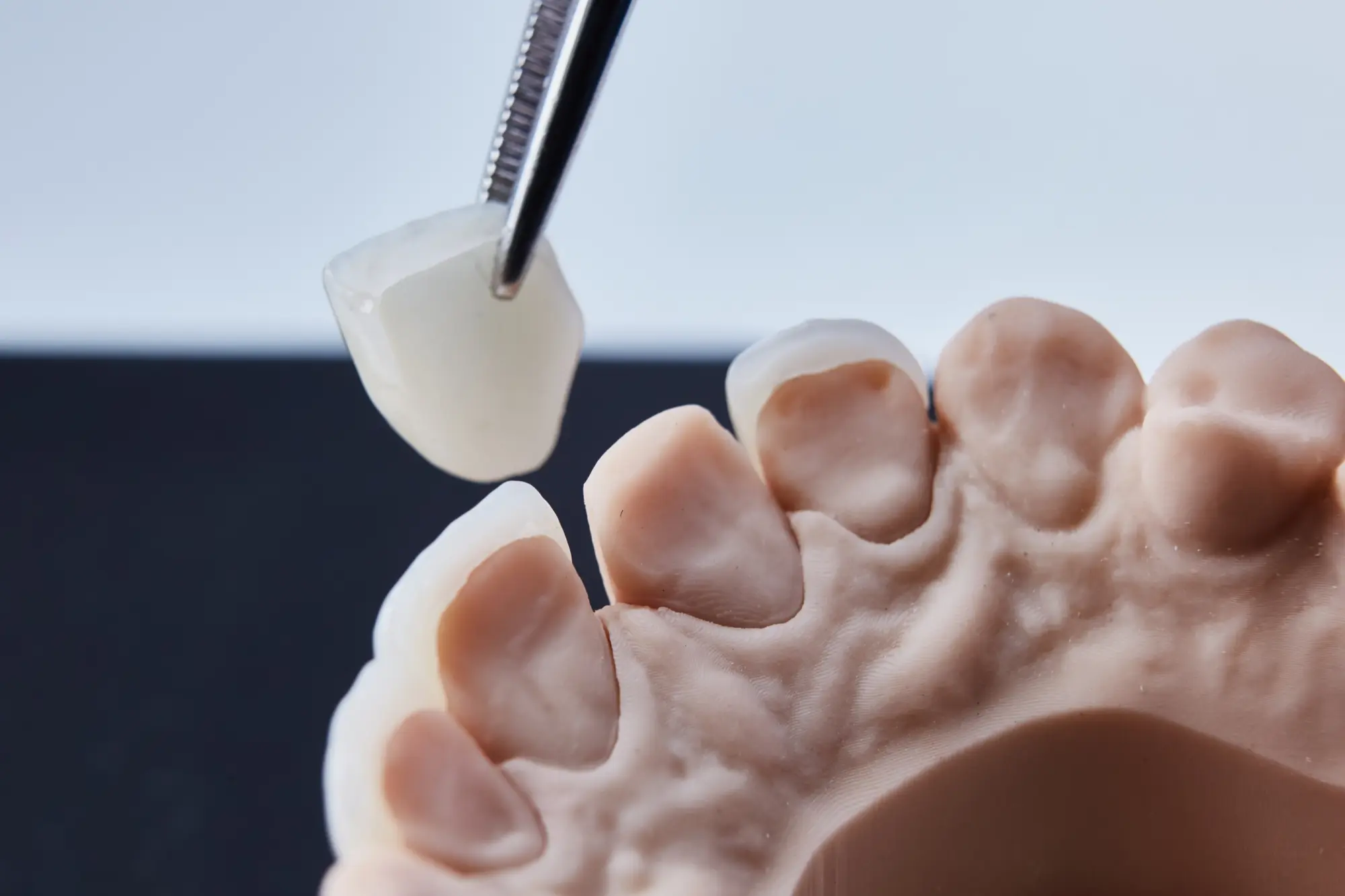 What to Do if Your Temporary Crown Comes Off