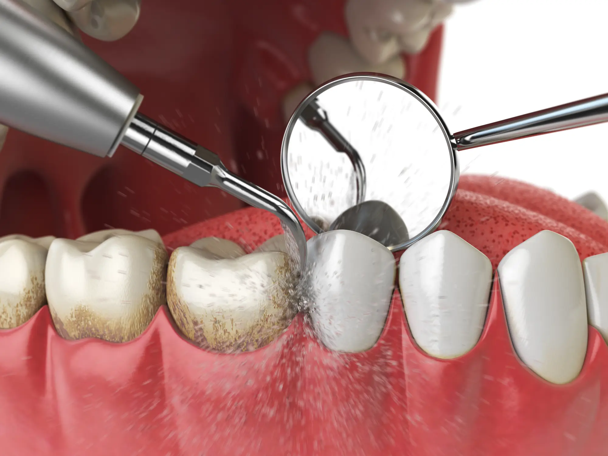 5 Signs You're Overdue for a Dental Cleaning
