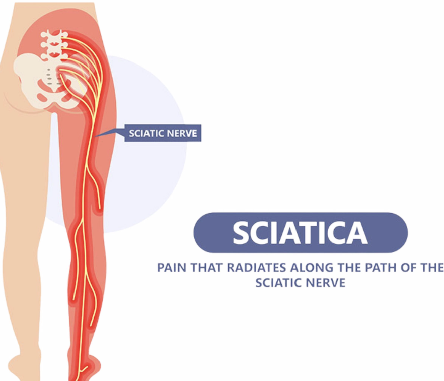 😩 Tired of Sciatica? Find Comfort for Radiating Pain in Buffalo, NY.
