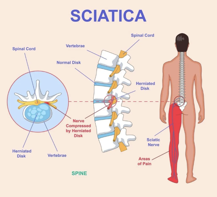 Decoding Sciatica Symptoms: A Guide to Nerve Pain in Buffalo, NY ⚡