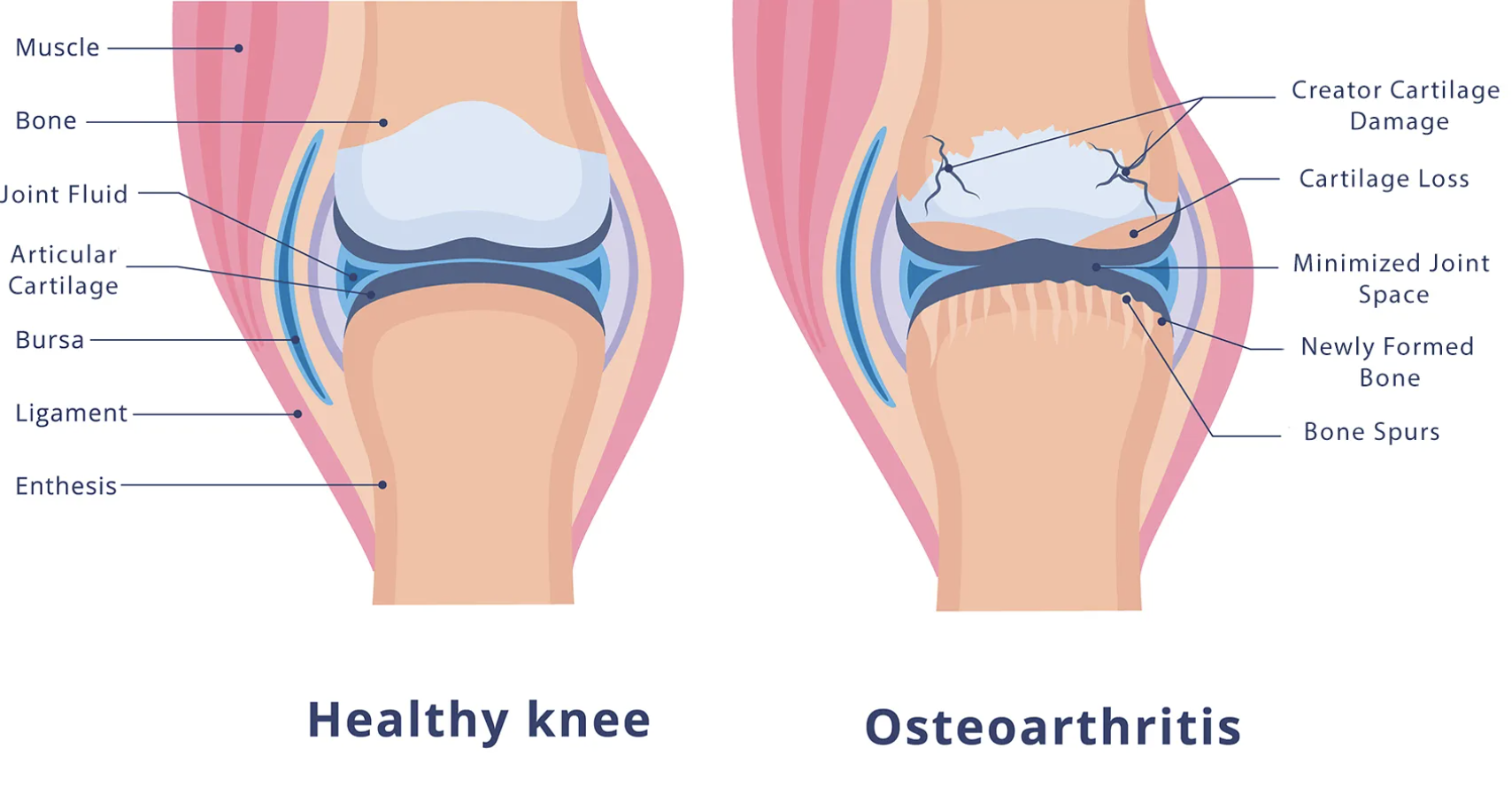 Why Do Knees Crack, Pop, or Grind?