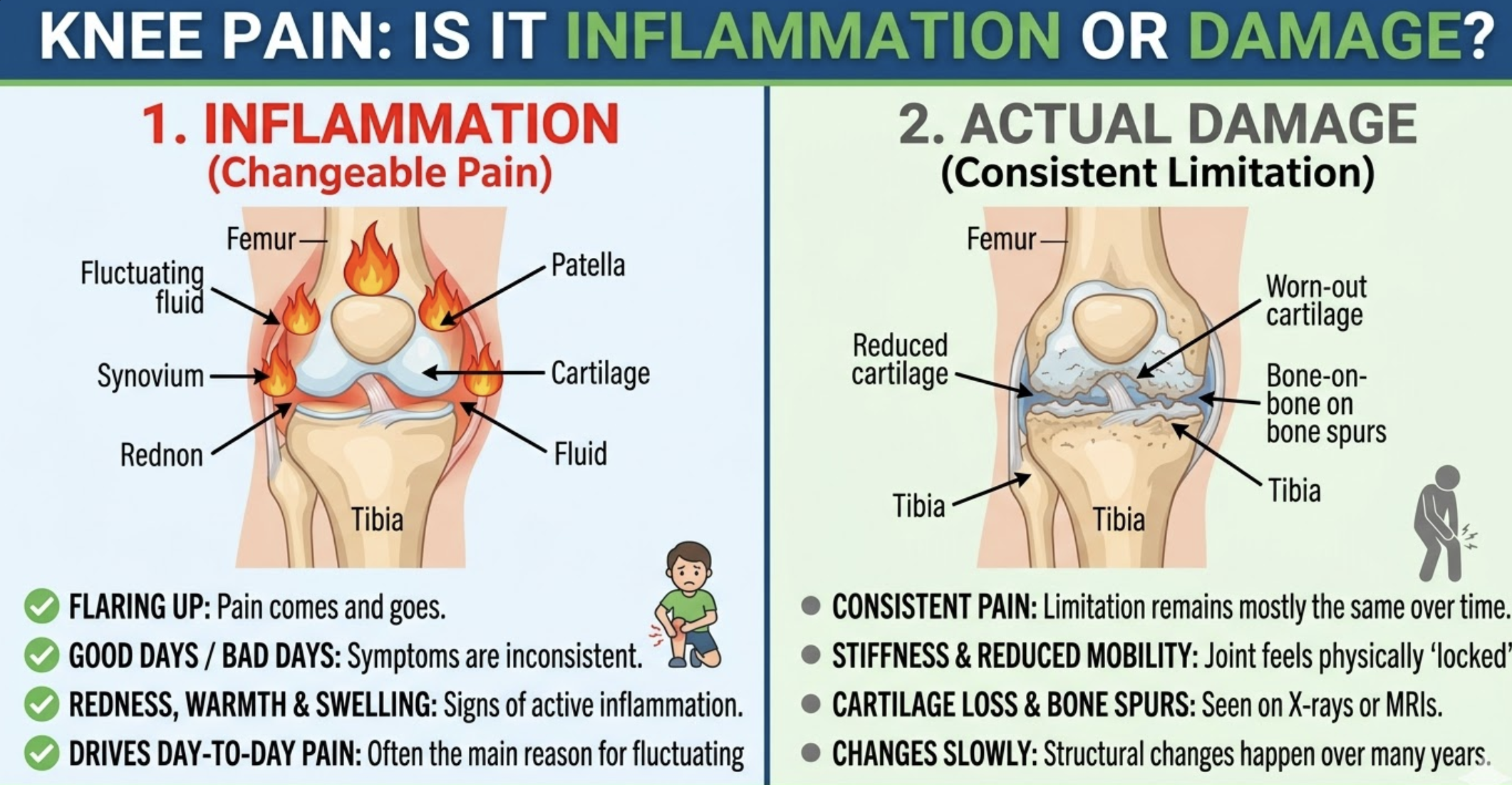 Is Your Knee Pain Coming from Inflammation or Damage?